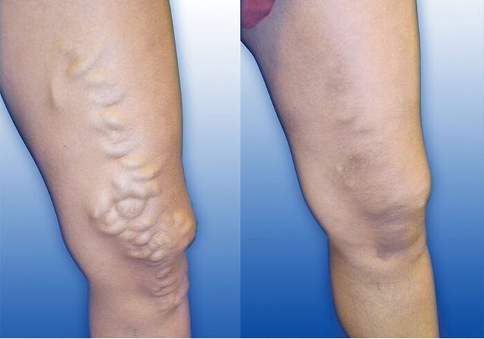 The causes of varicose veins