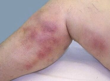 Varicose vein complications