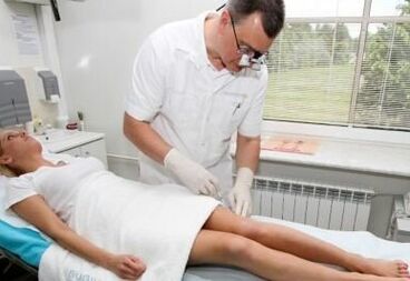 Varicose veins
