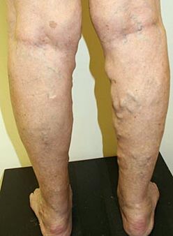 Varicose veins in the legs