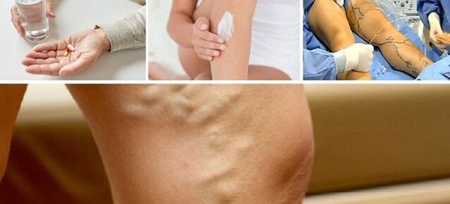 Varicose veins