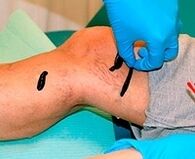 Leech for varicose veins