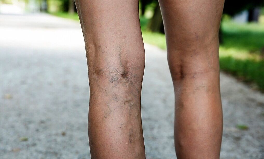 Expanded veins in the legs