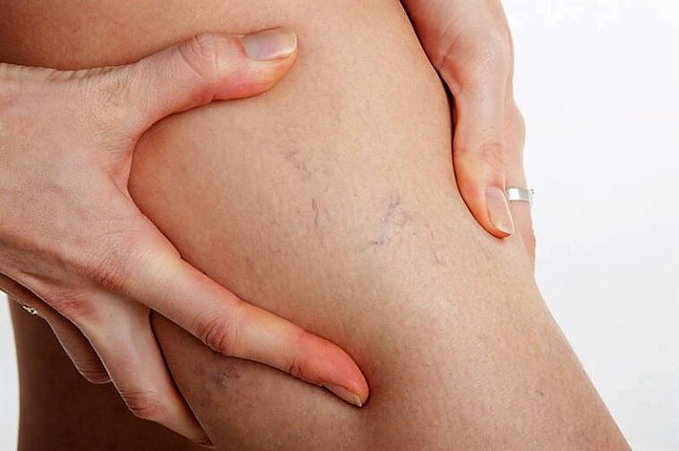 Varicose grid in the leg