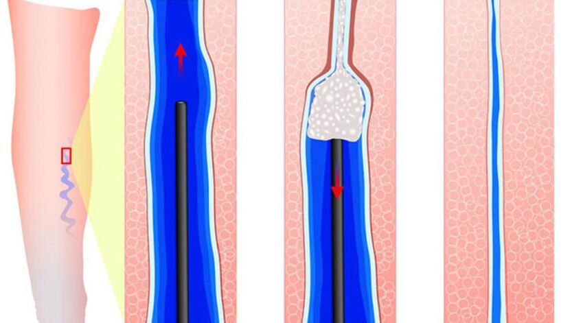 Introduction of Sclerotai in Sclerotherapy