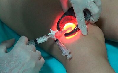 Sclerotherapy as a way to treat varicose veins in the legs