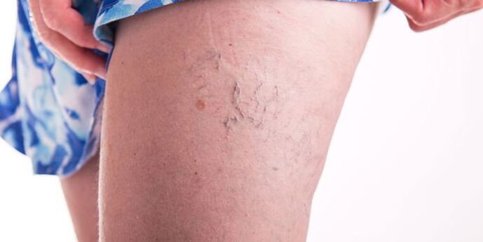 Ways to treat veins varicose veins