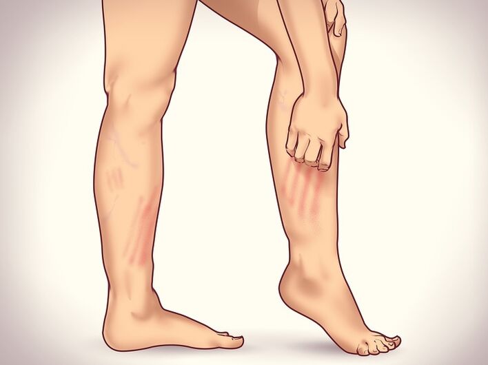6 Non -obvious signals of varicose veins