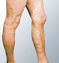 Varicose veins manifestations