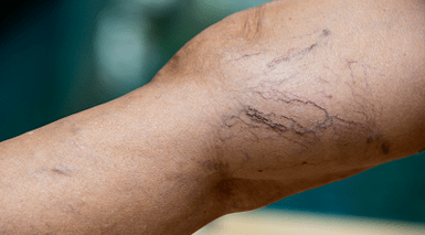 varicose vein prevention