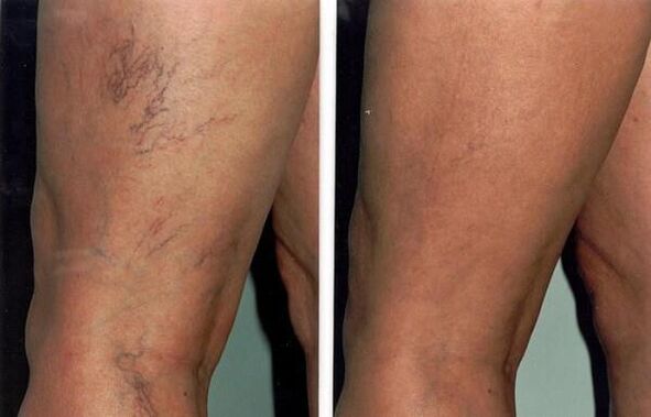 photos before and after varicose veins treatment